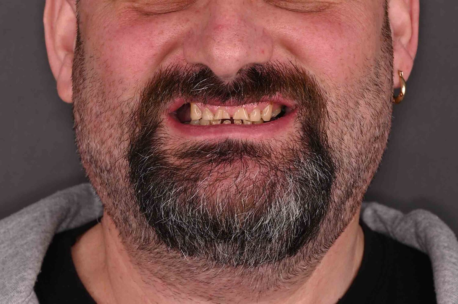 Pacient Clinica Dr. Alin Odor - Rezultat Implantologie